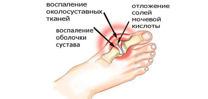 Визуализация раздела Подагра: признаки и лечение «болезни богатых людей»