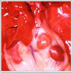 заболевания надпочечеников